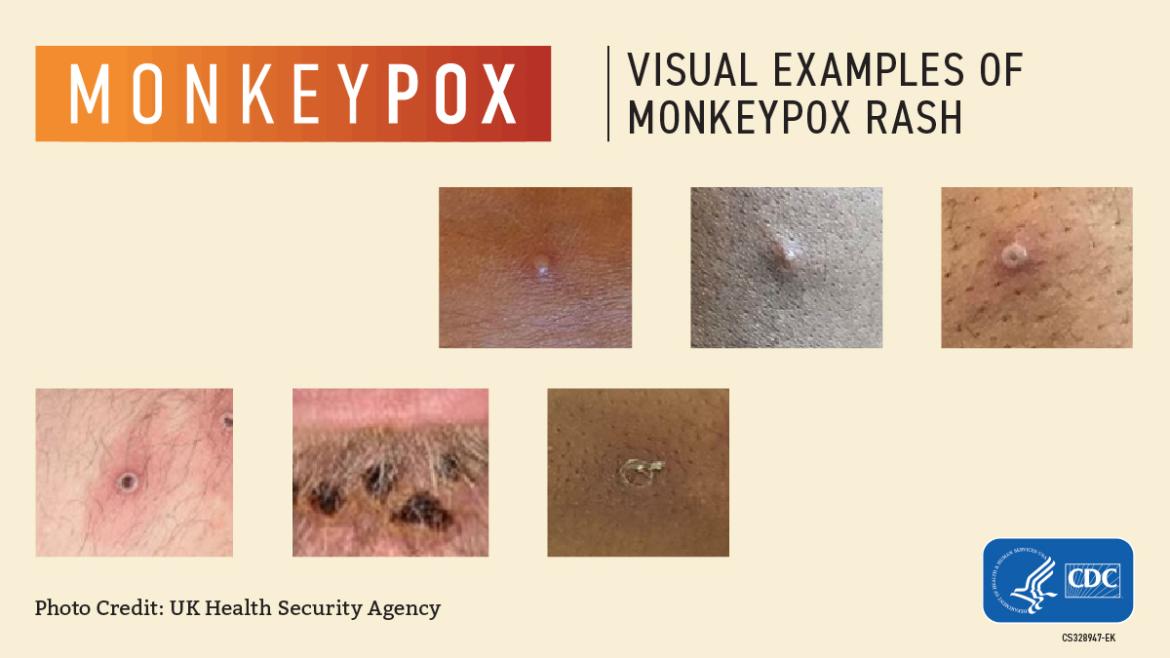 What You Should Know About Monkeypox, Lexington Medical Center Blog