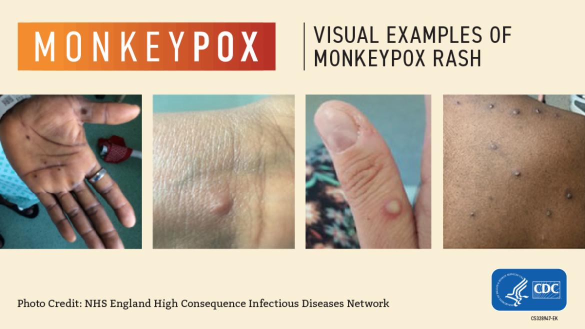 Monkeypox - Los Angeles, CA