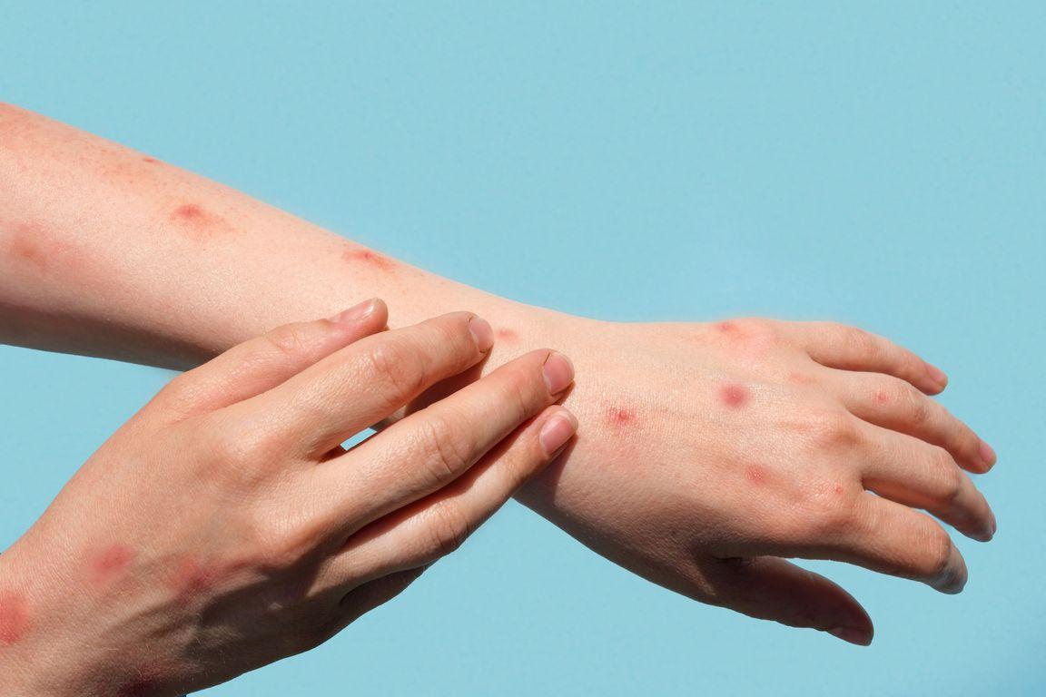 Photo of monkeypox rash on arms and hands